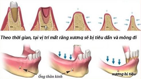 Tieu-xuong-rang